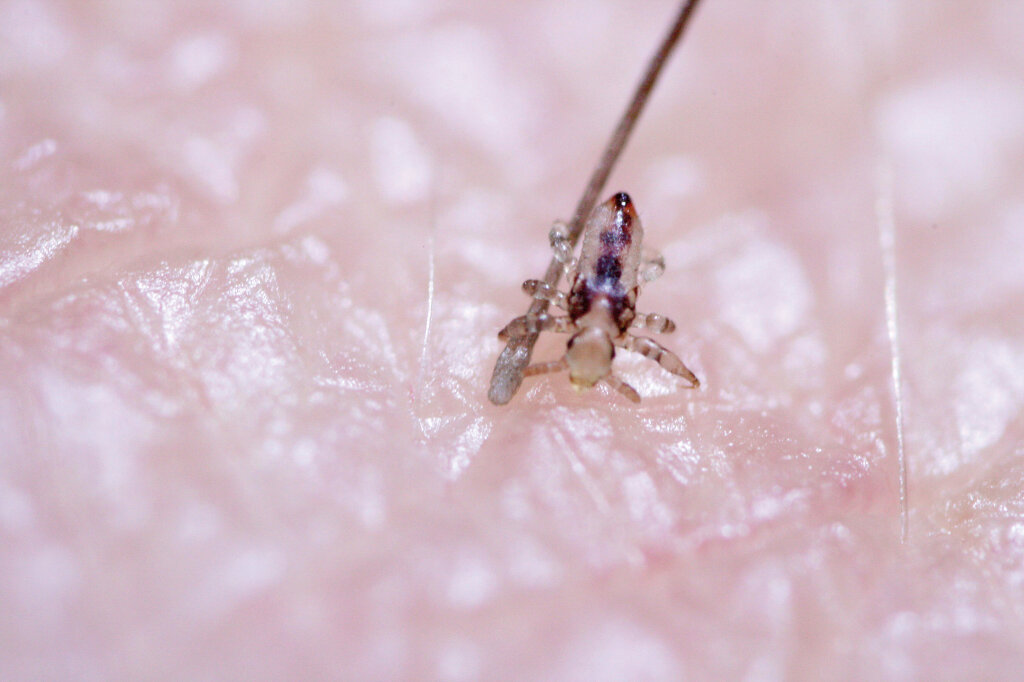 Kopfläuse können weder springen noch fliegen, sie krabbeln über die Haare: Dort kleben sie Nissen an, daraus entstehen Larven, und es entwickeln sich Lausweibchen und Lausmännchen. Foto: Deutsche Pediculosis Gesellschaft e.V.
